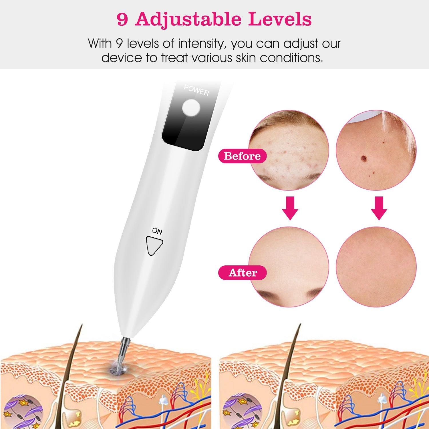 2 PCS Skin Tag Repair Kit Portable Beauty Equipment Multi-Level With Home Usage USB Charging LCD Level Adjustable 12 Replaceable Needles